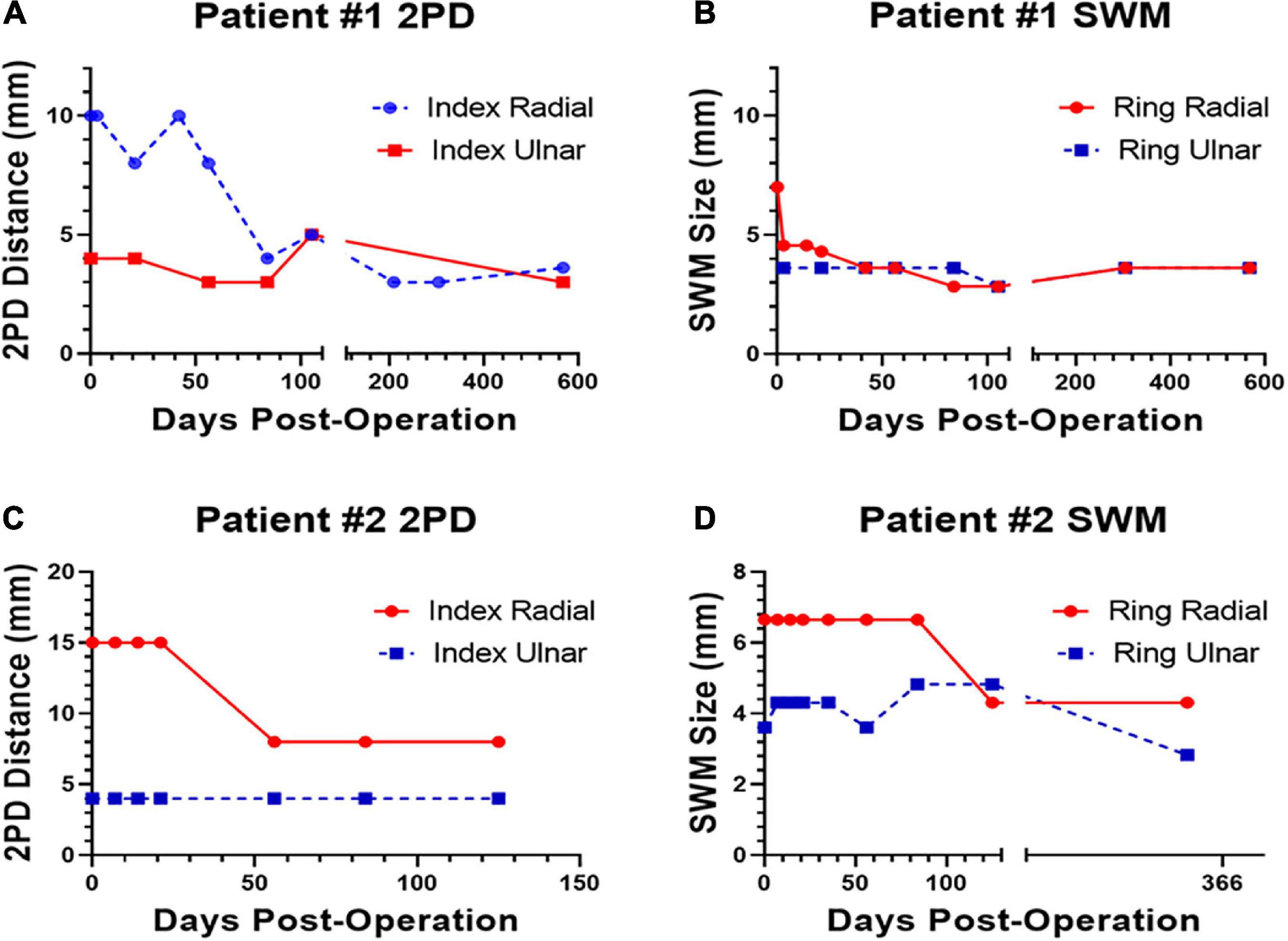 Rapid and effective fusion repair of severed digital nerves using neurorrhaphy and bioengineered solutions including polyethylene glycol: A case report